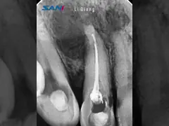 Dental Rotary File For Root Canal Retreatment 04/25 04/30